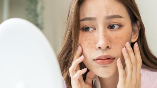 Benarkah Melasma Tak Boleh Dilaser? Ini Fakta